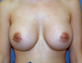 Patient # 40255 After Photo # 2